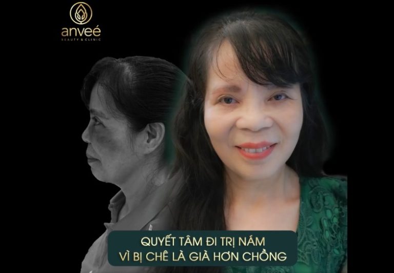 Quyết tâm trị nám đổi mới nhan sắc